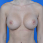After breast augmentation front view case 876