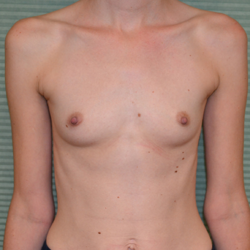 Before breast augmentation front view case 922