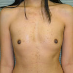 Before breast augmentation front view case 900