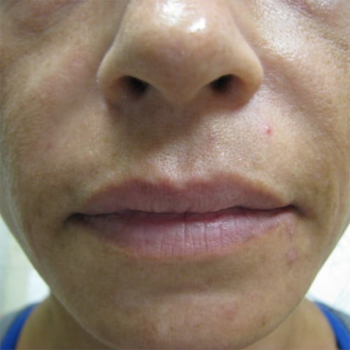 Nasolabial fold closeup after restylane case 1231