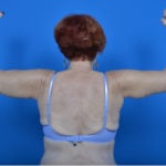 Female patient arm lift after photo back view case 760