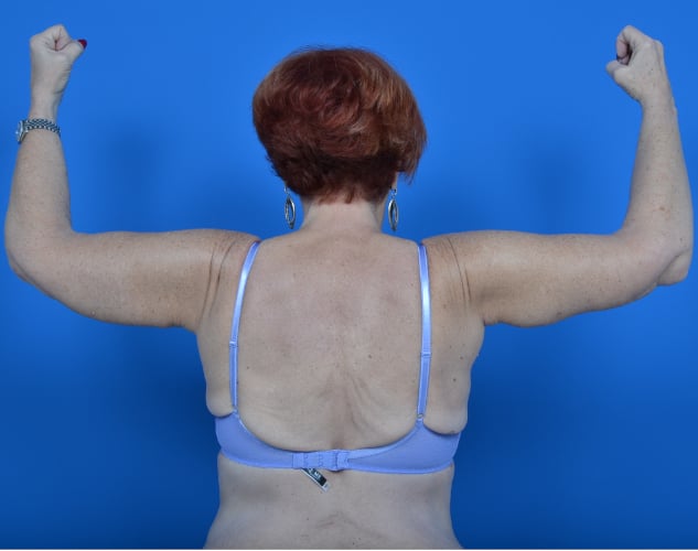 Female patient arm lift after photo back view case 760