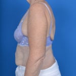 Patient's arm after brachioplasty case 760