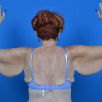 Female patient arm lift before photo back view case 1204