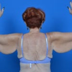 Female patient arm lift before photo back view case 1204