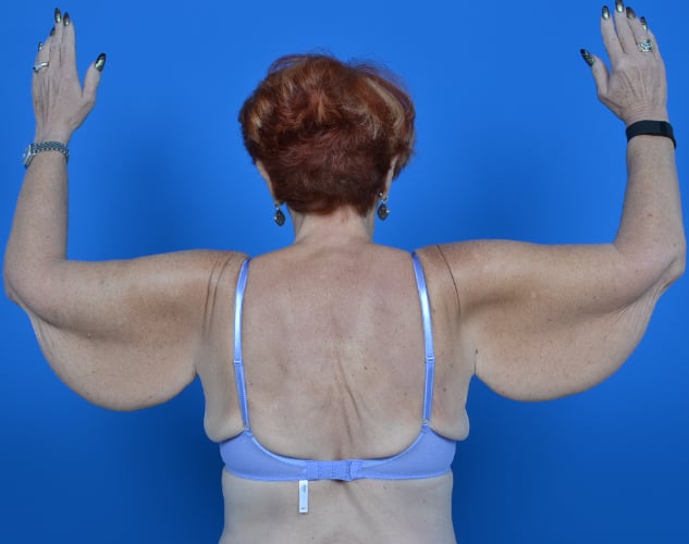 Female patient arm lift before photo back view case 1204