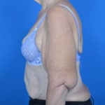 Patient's arm before brachioplasty case 760