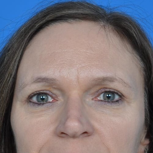 After eyelid surgery case 943