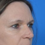 After eyelid surgery oblique view case 943