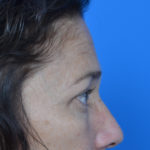 After eyelid surgery case 938 profile view