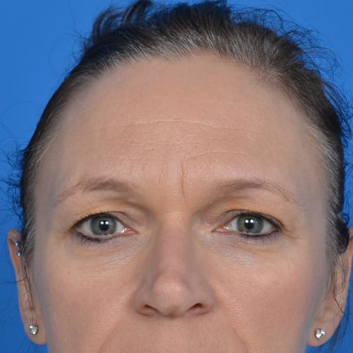 Blepharoplasty before image front view case 943