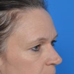 Before eyelid surgery oblique view case 943