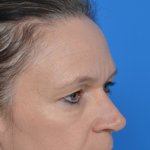 Before eyelid surgery oblique view case 943