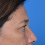 Before eyelid surgery side view case 938