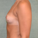 Before breast augmentation case 844 left profile view