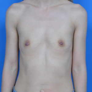 Before breast augmentation front view case 837