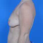 Before breast lift left side view case 778