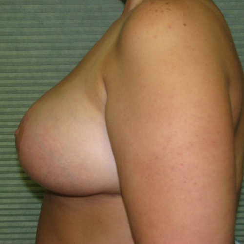 Side view of breasts after reduction case 820