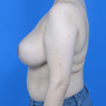After breast reduction left side case 825