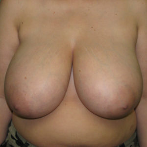 Before breast reduction case 820 front view
