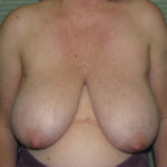 Before breast reduction front view case 832