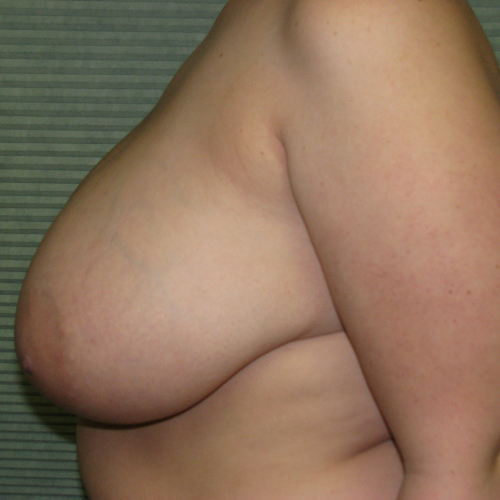 Before breast reduction side view case 820
