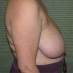 Before breast reduction right side view case 832