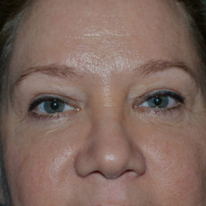 Upper and lower blepharoplasty and browlift case 929