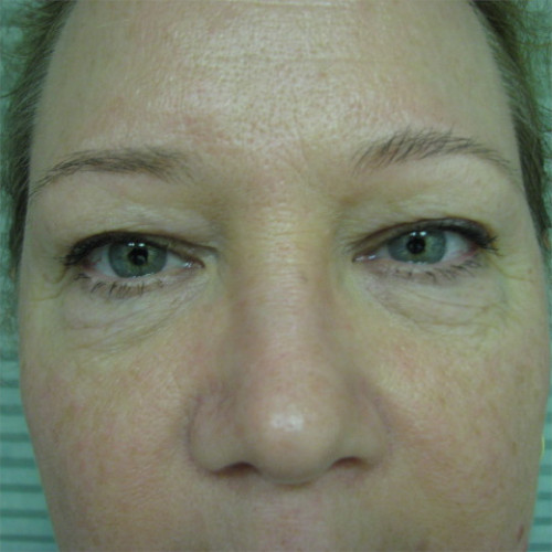 Before blepharoplasty and browlift case 929