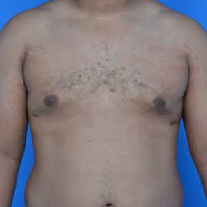 Gynecomastia after surgery front view case 951