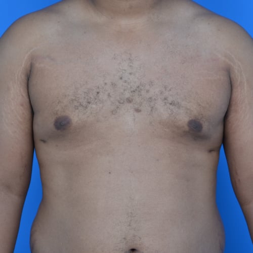 Gynecomastia after surgery front view case 951