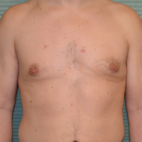 Gynecomastia after surgery front view case 958
