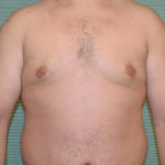 Gynecomastia after surgery front view case 965