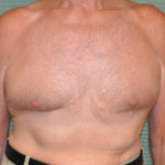 After male breast reduction front view case 972