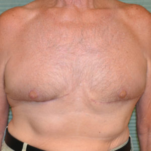 After male breast reduction front view case 972