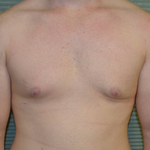After male breast reduction front case 984