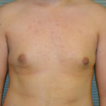 After male breast reduction front view case 984