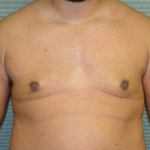 After gynecomastia surgery front view case 991