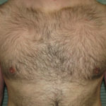 After male breast reduction front view case 999