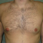 After male breast reduction front view case 1004