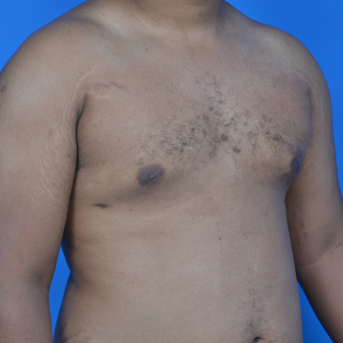 Gynecomastia after surgery right oblique view case 951
