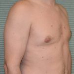Gynecomastia after surgery right oblique view case 958