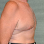 After male breast reduction oblique view case 972