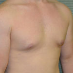 After male breast reduction right oblique case 979
