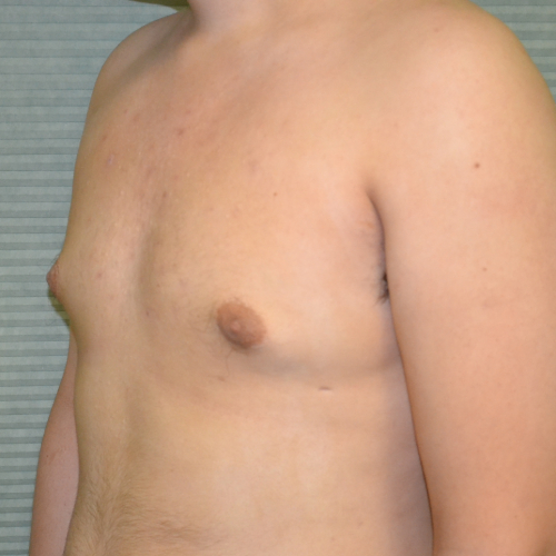 After male breast reduction left oblique case 984