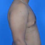 Gynecomastia after surgery right profile view case 951