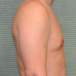Gynecomastia after surgery right profile view case 958
