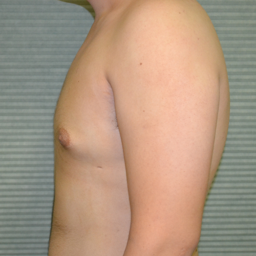 After breast reduction male patient case 984