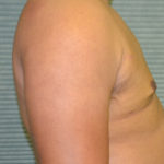 After male breast reduction right profile case 991