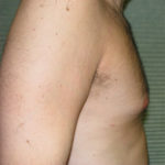 After male breast reduction right profile case 1004